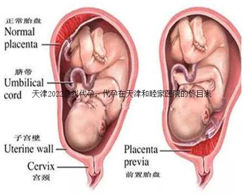 天津2022急找代孕，代孕在天津和睦家医院的价目表